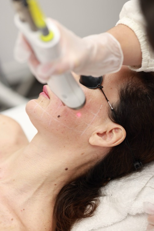 Rejuvenecimiento 4D Fotona · Impuls Longevity Barcelona