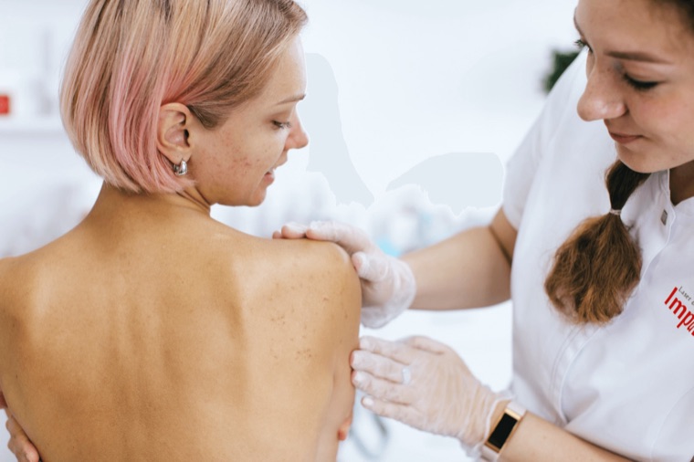 Tratamiento del acné · Impuls Longevity Barcelona