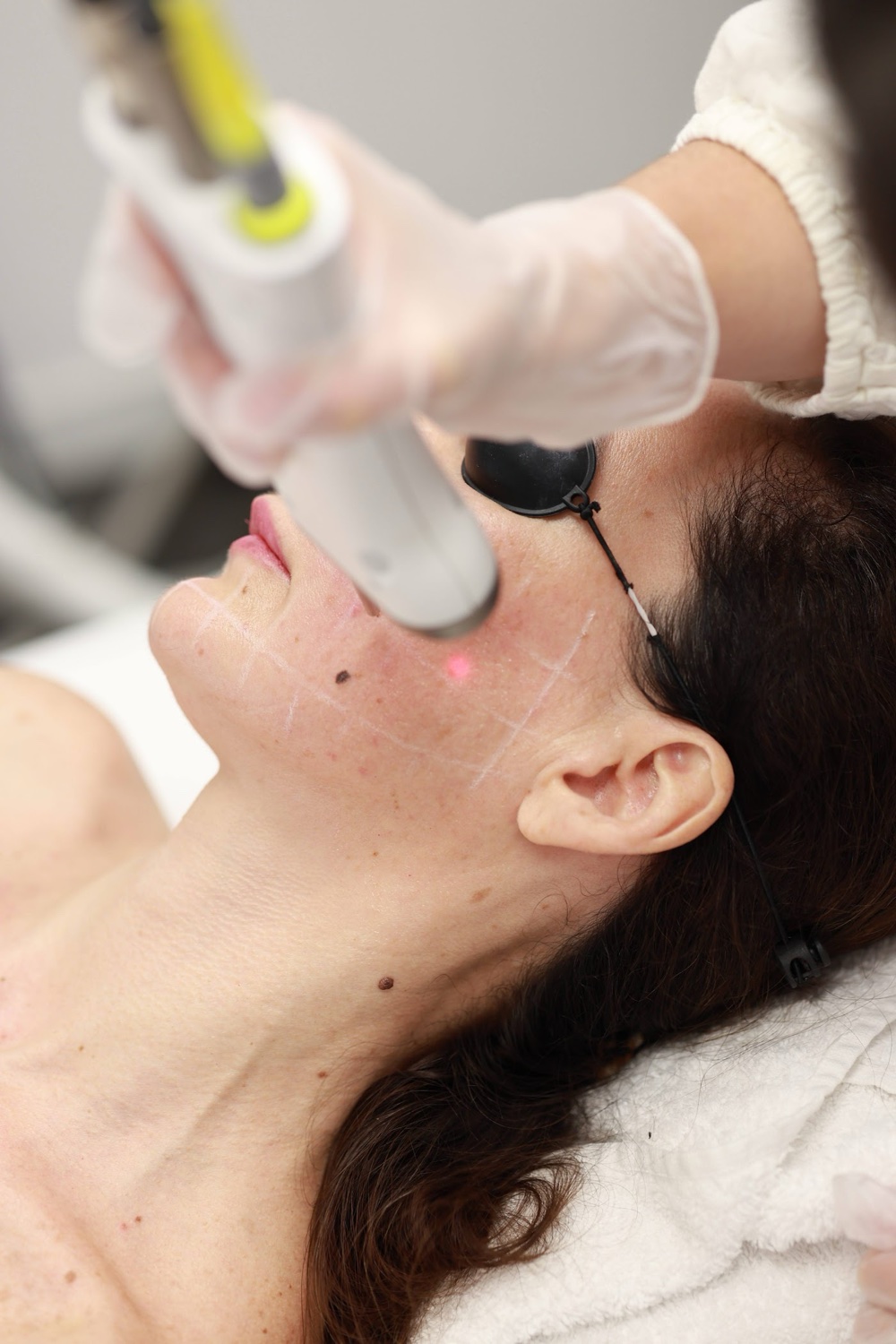 Fotona Lift · Impuls Longevity